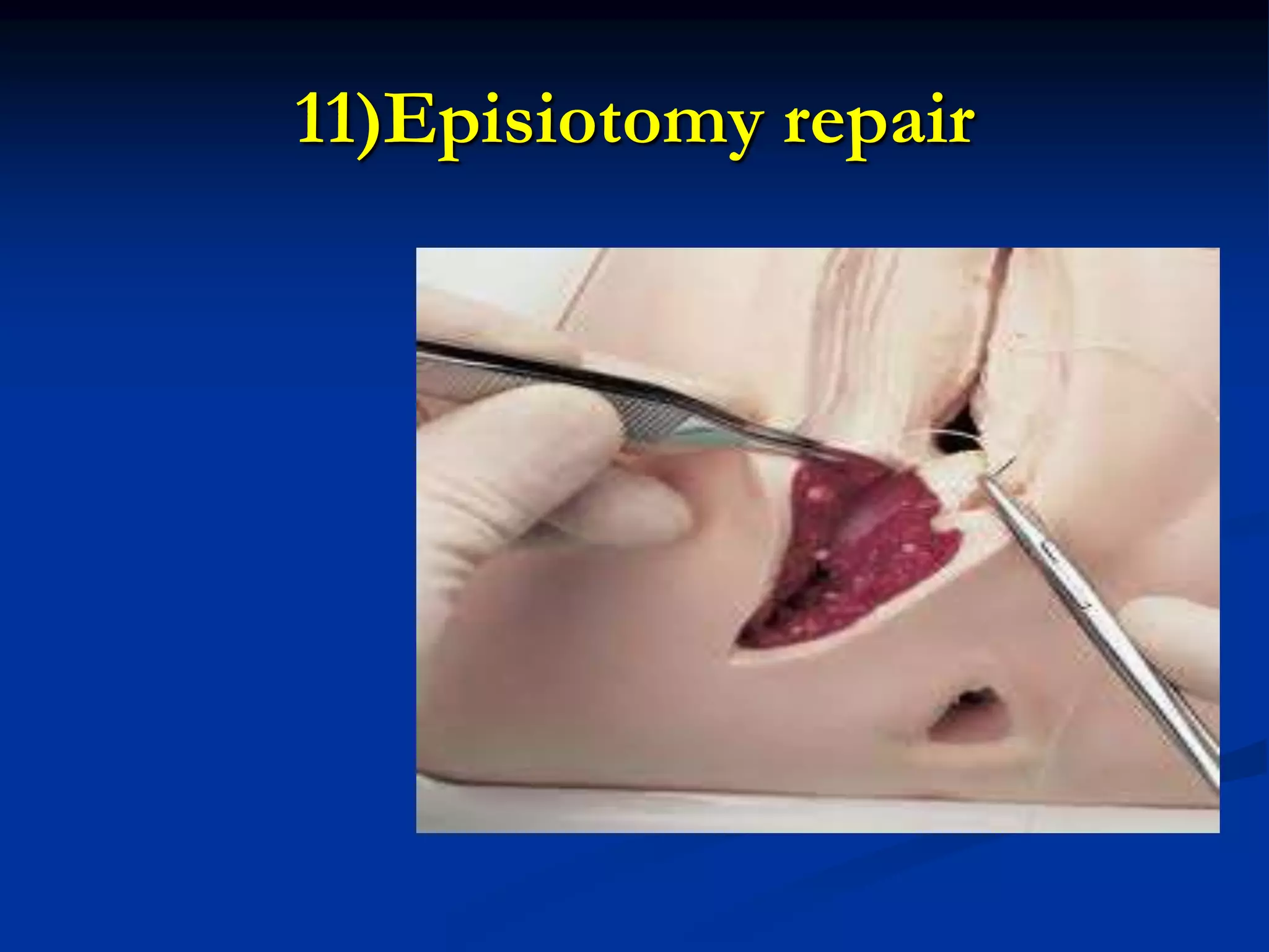 11)Episiotomy repair
 