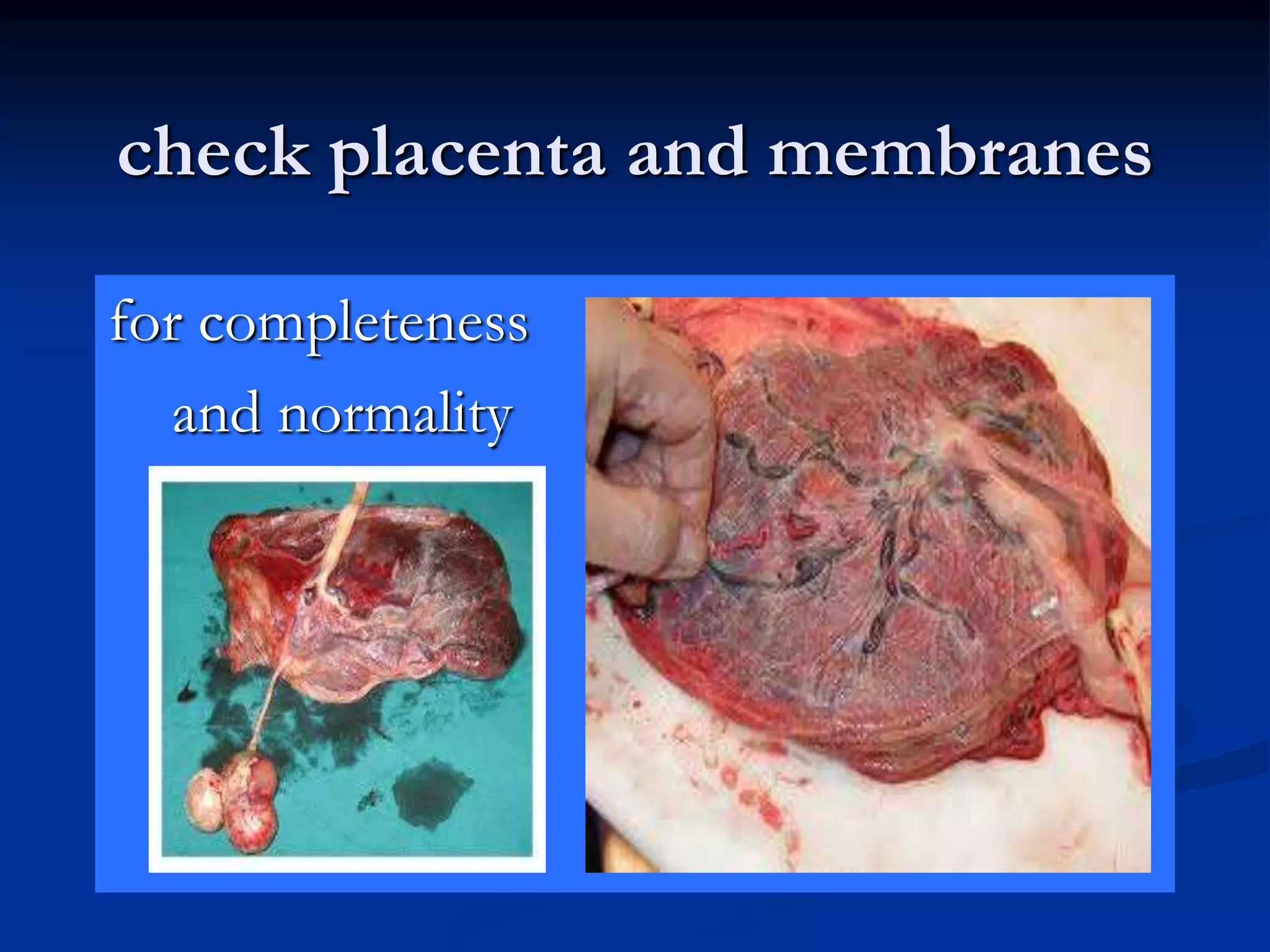 check placenta and membranes
for completeness
and normality
 
