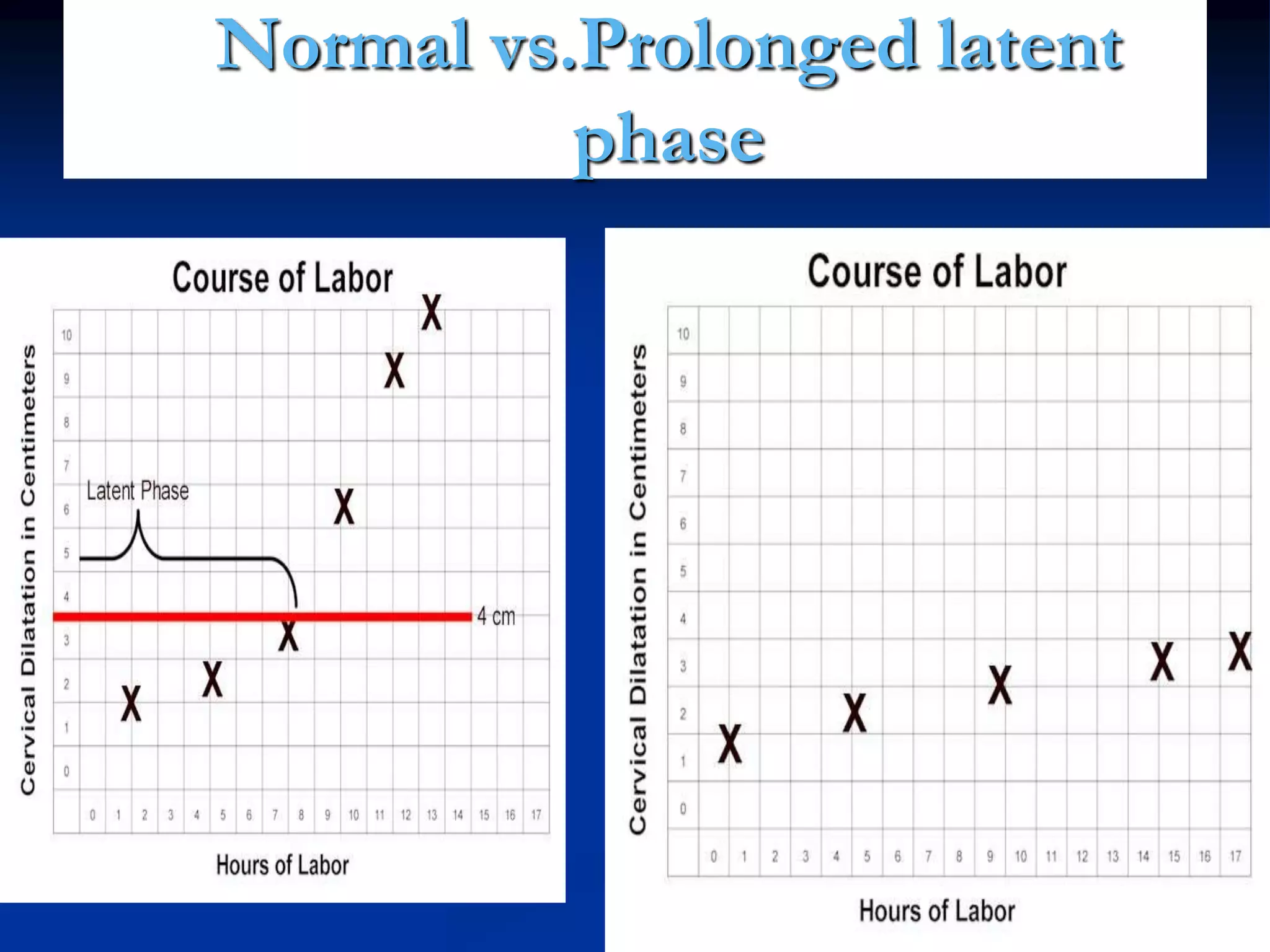 Normal vs.Prolonged latent
phase
 