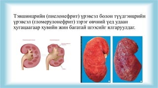 Тэвшинцрийн (пиелонефрит) үрэвсэл болон түүдгэнцрийн
үрэвсэл (гломерулонефрит) зэрэг өвчний үед удаан
хугацаагаар хувийн жин багатай шээсийг ялгаруулдаг.
 