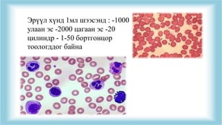 Эрүүл хүнд 1мл шээсэнд : -1000
улаан эс -2000 цагаан эс -20
цилиндр - 1-50 бортгонцор
тоологддог байна
 