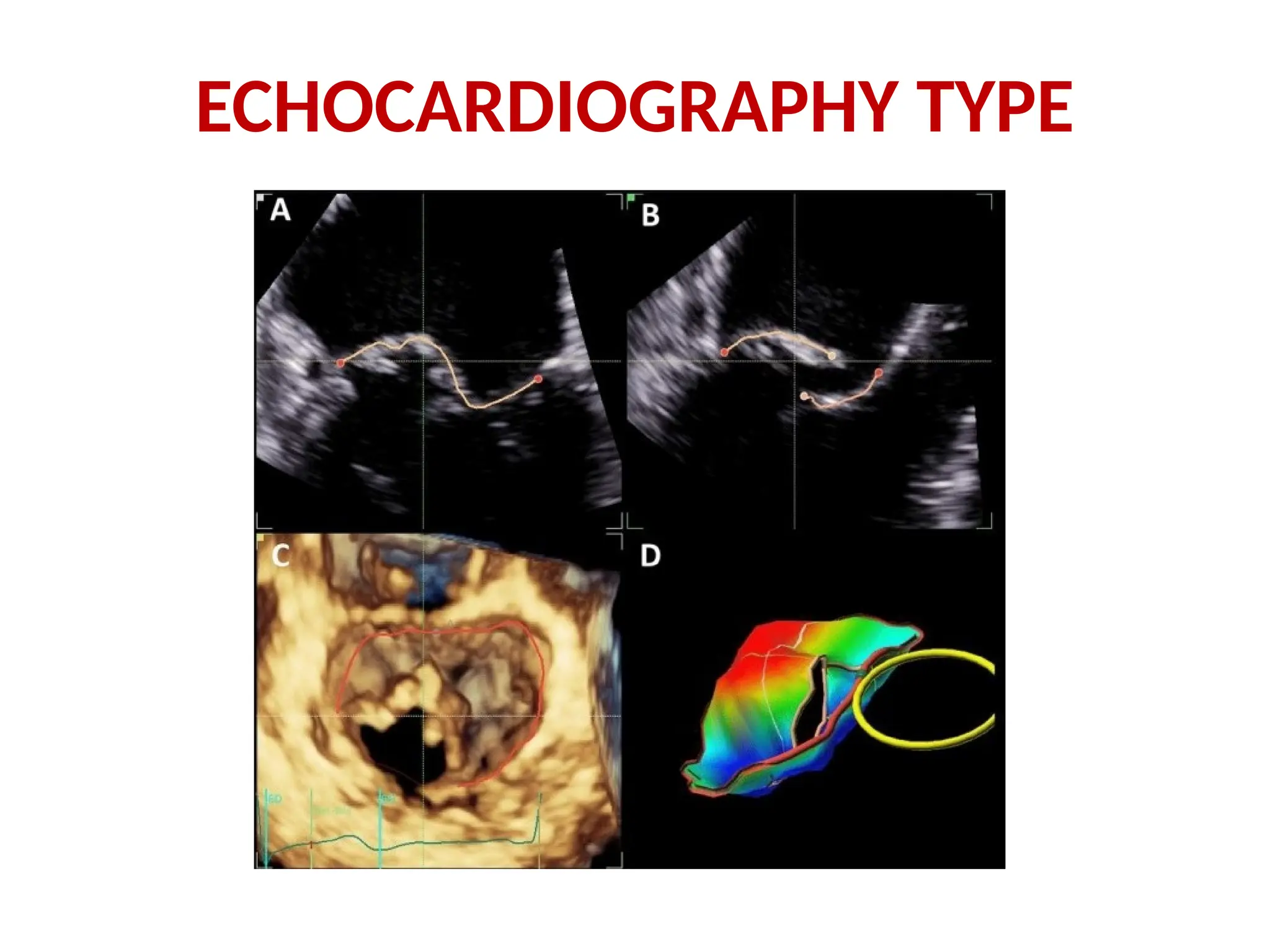 ECHOCARDIOGRAPHY TYPE
 