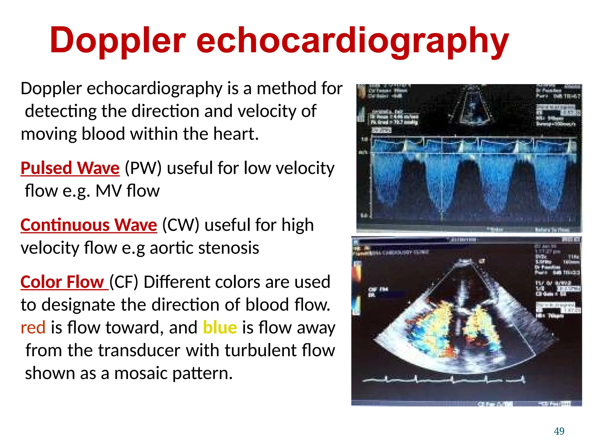 Doppler echocardiography
49
Doppler echocardiography is a method for
detecting the direction and velocity of
moving blood within the heart.
Pulsed Wave (PW) useful for low velocity
flow e.g. MV flow
Continuous Wave (CW) useful for high
velocity flow e.g aortic stenosis
Color Flow (CF) Different colors are used
to designate the direction of blood flow.
red is flow toward, and blue is flow away
from the transducer with turbulent flow
shown as a mosaic pattern.
 