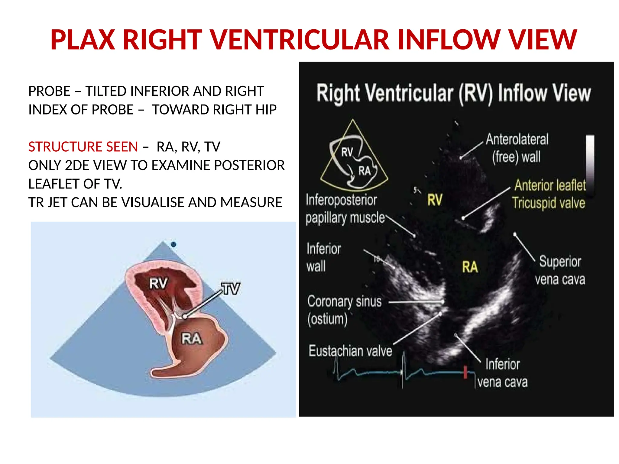 PLAX RIGHT VENTRICULAR INFLOW VIEW
PROBE – TILTED INFERIOR AND RIGHT
INDEX OF PROBE – TOWARD RIGHT HIP
STRUCTURE SEEN – RA, RV, TV
ONLY 2DE VIEW TO EXAMINE POSTERIOR
LEAFLET OF TV.
TR JET CAN BE VISUALISE AND MEASURE
 