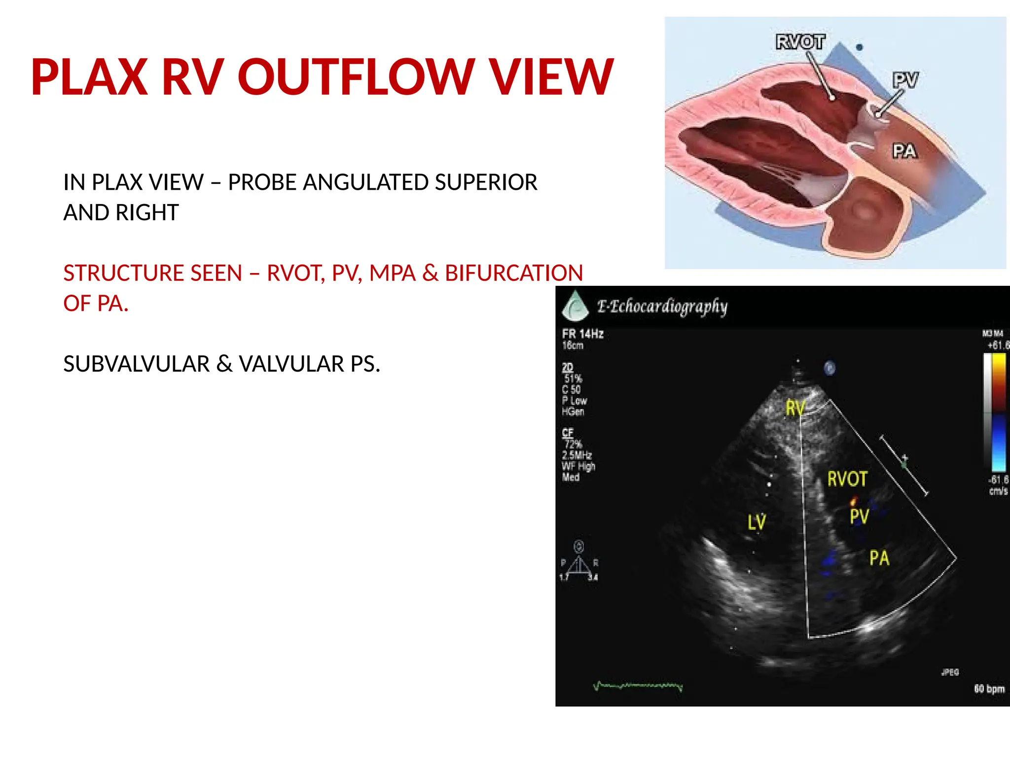 PLAX RV OUTFLOW VIEW
IN PLAX VIEW – PROBE ANGULATED SUPERIOR
AND RIGHT
STRUCTURE SEEN – RVOT, PV, MPA & BIFURCATION
OF PA.
SUBVALVULAR & VALVULAR PS.
 