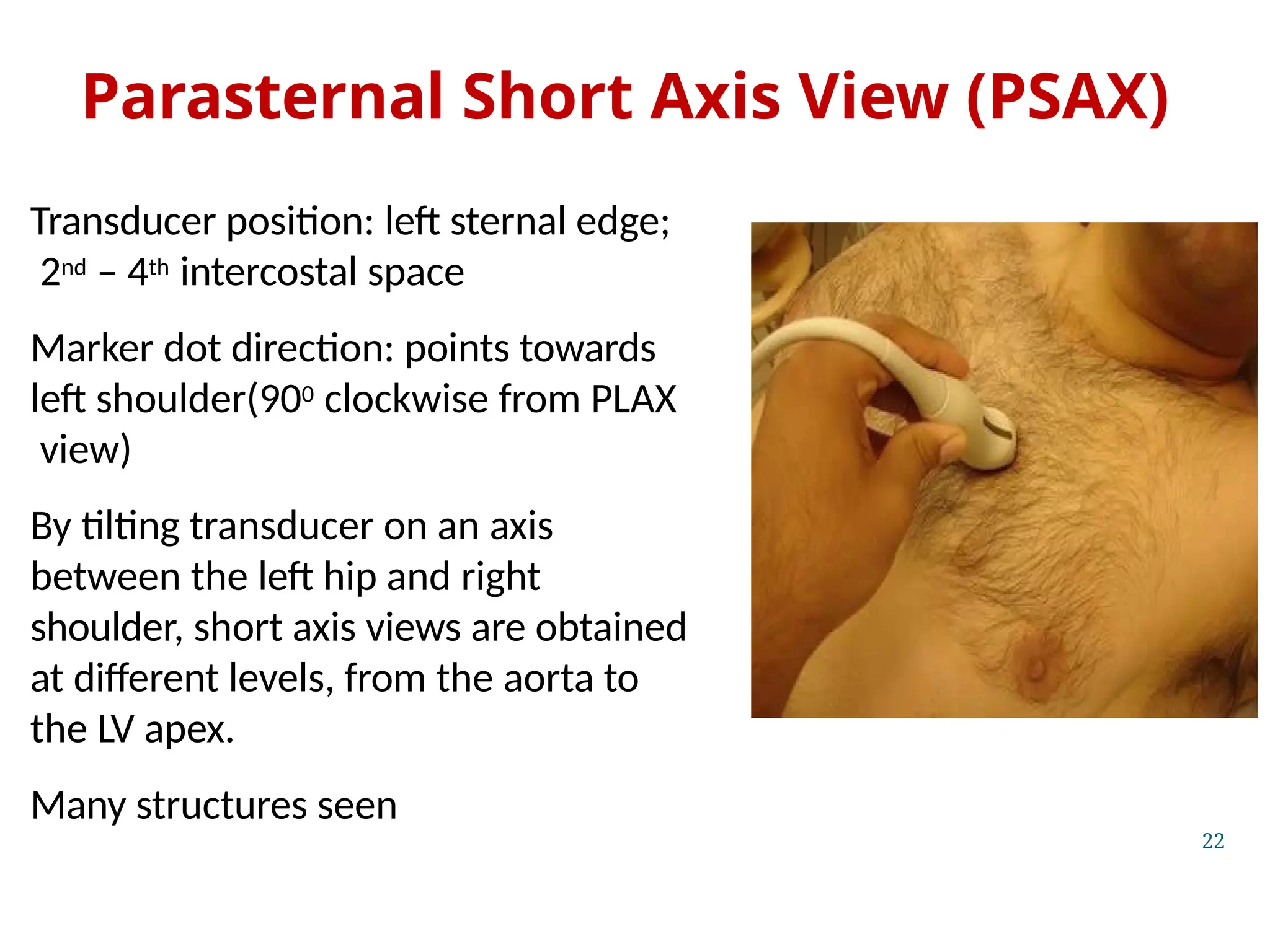Parasternal Short Axis View (PSAX)
Transducer position: left sternal edge;
2nd – 4th intercostal space
Marker dot direction: points towards
left shoulder(900 clockwise from PLAX
view)
By tilting transducer on an axis
between the left hip and right
shoulder, short axis views are obtained
at different levels, from the aorta to
the LV apex.
Many structures seen
22
 