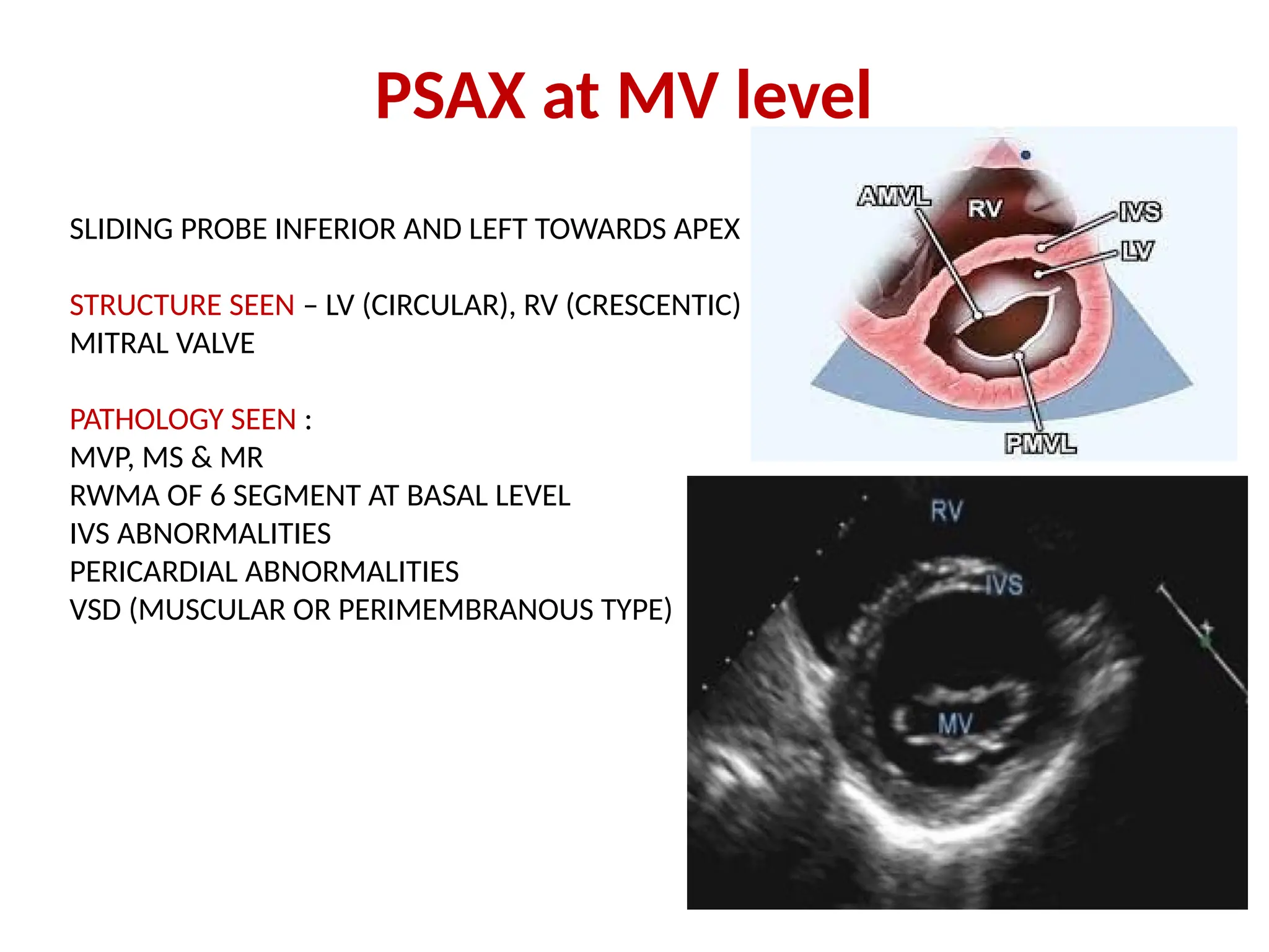 PSAX at MV level
SLIDING PROBE INFERIOR AND LEFT TOWARDS APEX
STRUCTURE SEEN – LV (CIRCULAR), RV (CRESCENTIC)
MITRAL VALVE
PATHOLOGY SEEN :
MVP, MS & MR
RWMA OF 6 SEGMENT AT BASAL LEVEL
IVS ABNORMALITIES
PERICARDIAL ABNORMALITIES
VSD (MUSCULAR OR PERIMEMBRANOUS TYPE)
 