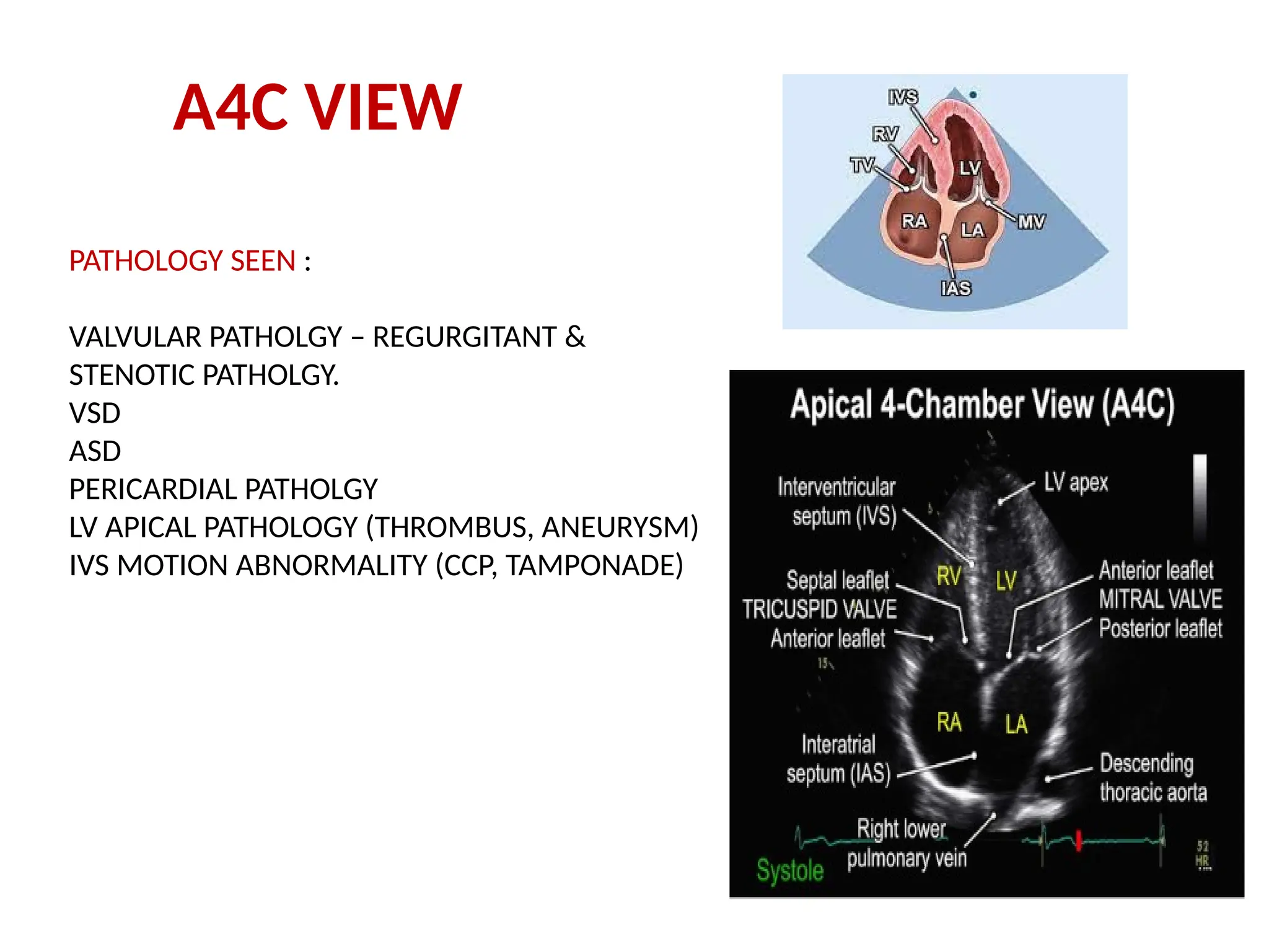 A4C VIEW
PATHOLOGY SEEN :
VALVULAR PATHOLGY – REGURGITANT &
STENOTIC PATHOLGY.
VSD
ASD
PERICARDIAL PATHOLGY
LV APICAL PATHOLOGY (THROMBUS, ANEURYSM)
IVS MOTION ABNORMALITY (CCP, TAMPONADE)
 