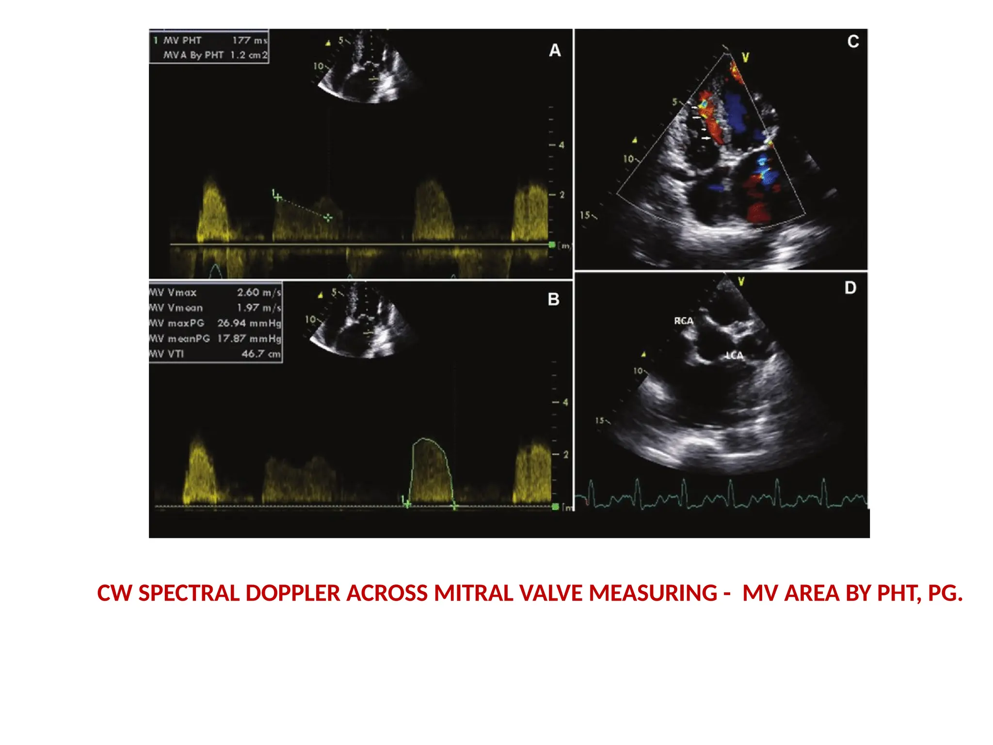 CW SPECTRAL DOPPLER ACROSS MITRAL VALVE MEASURING - MV AREA BY PHT, PG.
 