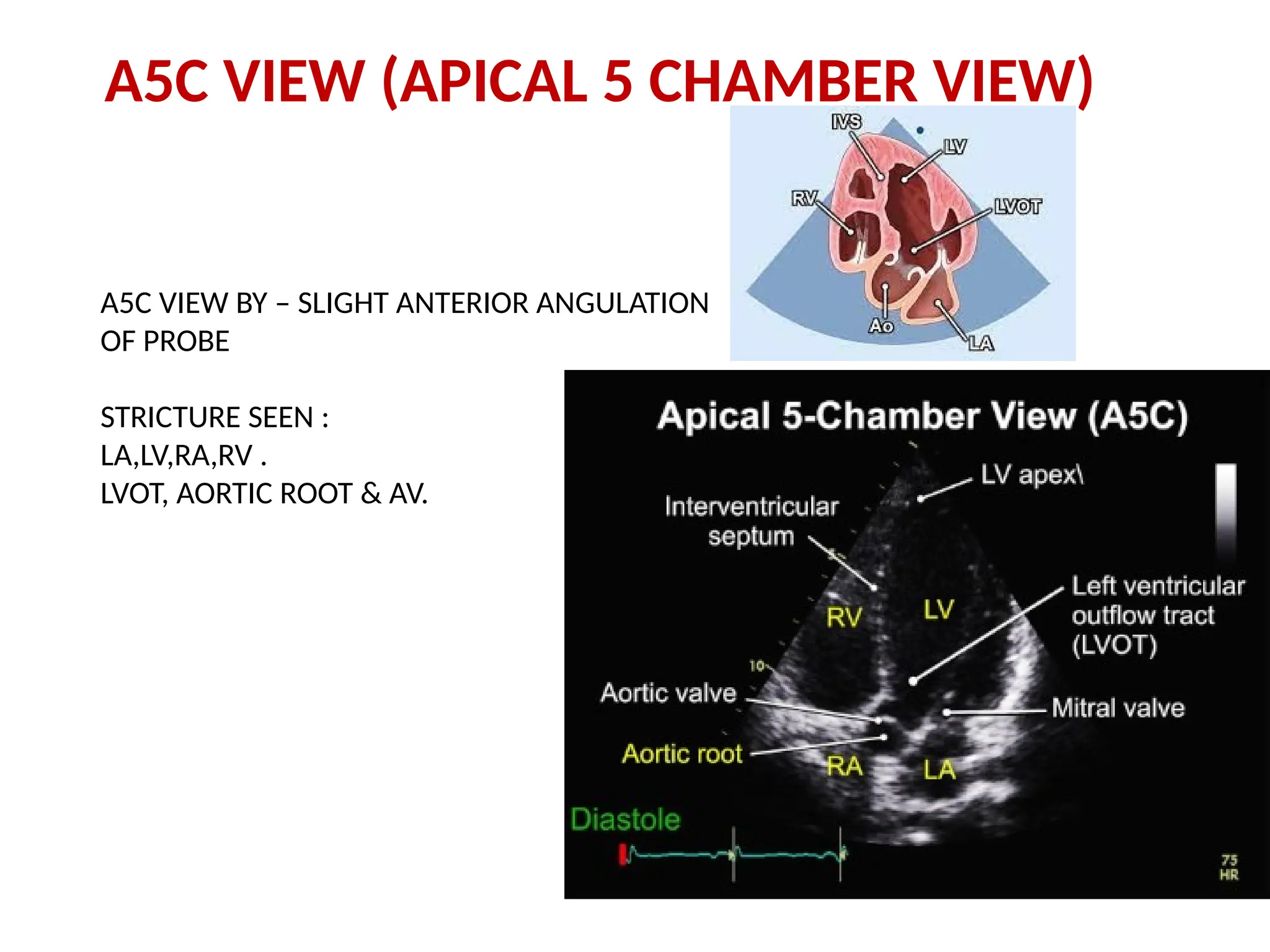 A5C VIEW (APICAL 5 CHAMBER VIEW)
A5C VIEW BY – SLIGHT ANTERIOR ANGULATION
OF PROBE
STRICTURE SEEN :
LA,LV,RA,RV .
LVOT, AORTIC ROOT & AV.
 