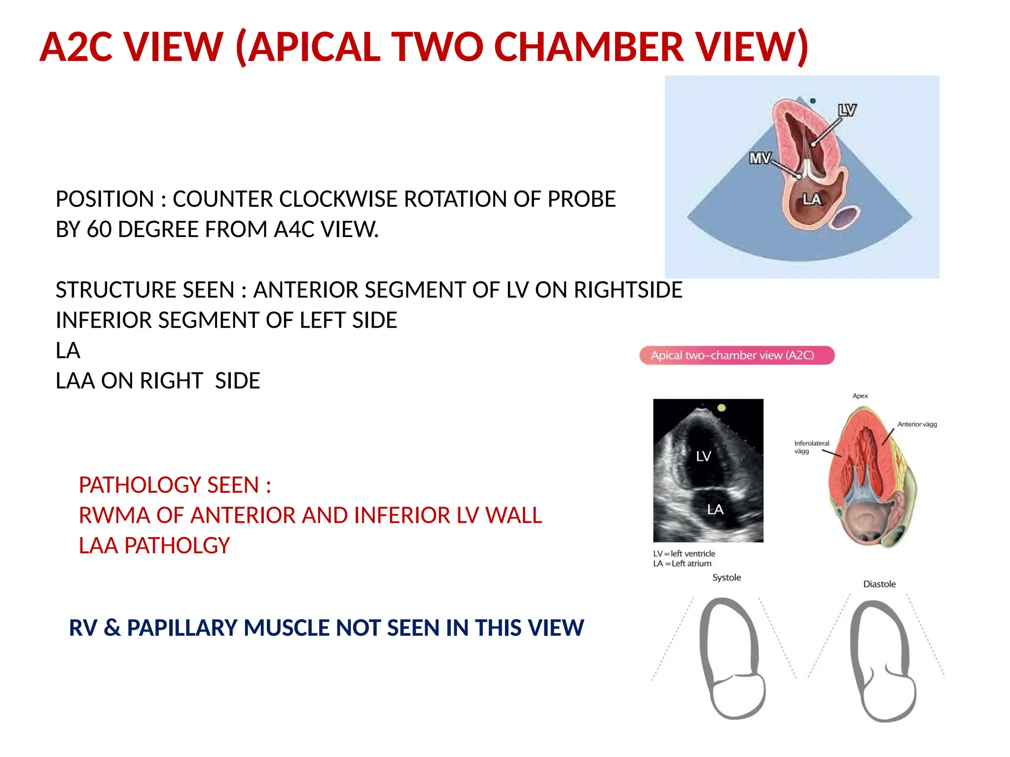 A2C VIEW (APICAL TWO CHAMBER VIEW)
POSITION : COUNTER CLOCKWISE ROTATION OF PROBE
BY 60 DEGREE FROM A4C VIEW.
STRUCTURE SEEN : ANTERIOR SEGMENT OF LV ON RIGHTSIDE
INFERIOR SEGMENT OF LEFT SIDE
LA
LAA ON RIGHT SIDE
PATHOLOGY SEEN :
RWMA OF ANTERIOR AND INFERIOR LV WALL
LAA PATHOLGY
RV & PAPILLARY MUSCLE NOT SEEN IN THIS VIEW
 