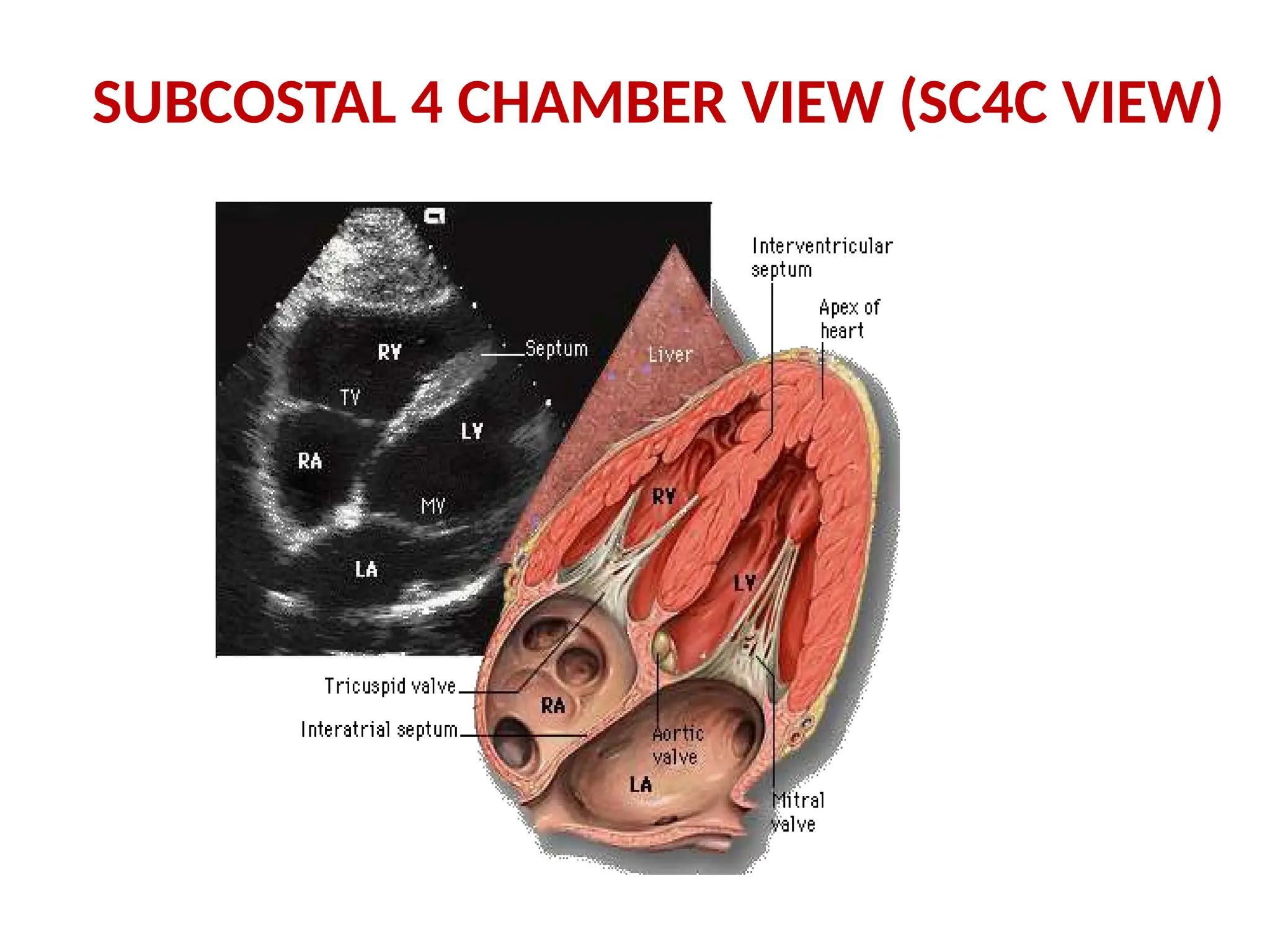 SUBCOSTAL 4 CHAMBER VIEW (SC4C VIEW)
 