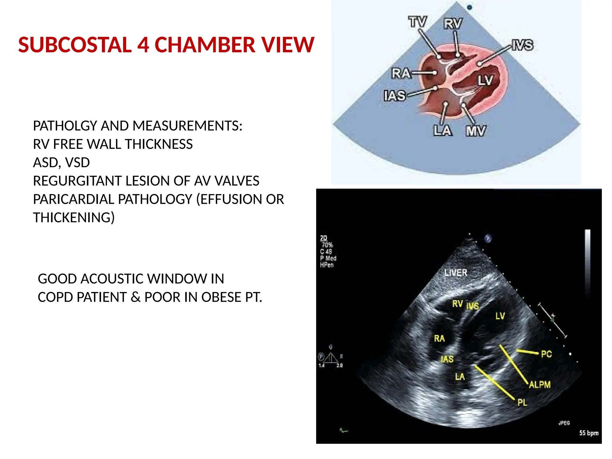 SUBCOSTAL 4 CHAMBER VIEW
PATHOLGY AND MEASUREMENTS:
RV FREE WALL THICKNESS
ASD, VSD
REGURGITANT LESION OF AV VALVES
PARICARDIAL PATHOLOGY (EFFUSION OR
THICKENING)
GOOD ACOUSTIC WINDOW IN
COPD PATIENT & POOR IN OBESE PT.
 