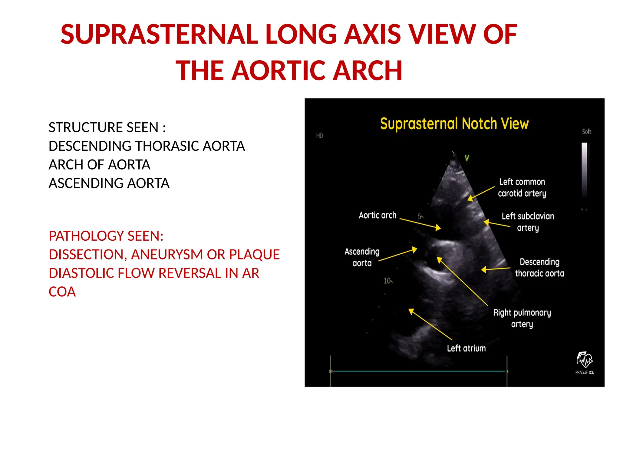 SUPRASTERNAL LONG AXIS VIEW OF
THE AORTIC ARCH
STRUCTURE SEEN :
DESCENDING THORASIC AORTA
ARCH OF AORTA
ASCENDING AORTA
PATHOLOGY SEEN:
DISSECTION, ANEURYSM OR PLAQUE
DIASTOLIC FLOW REVERSAL IN AR
COA
 