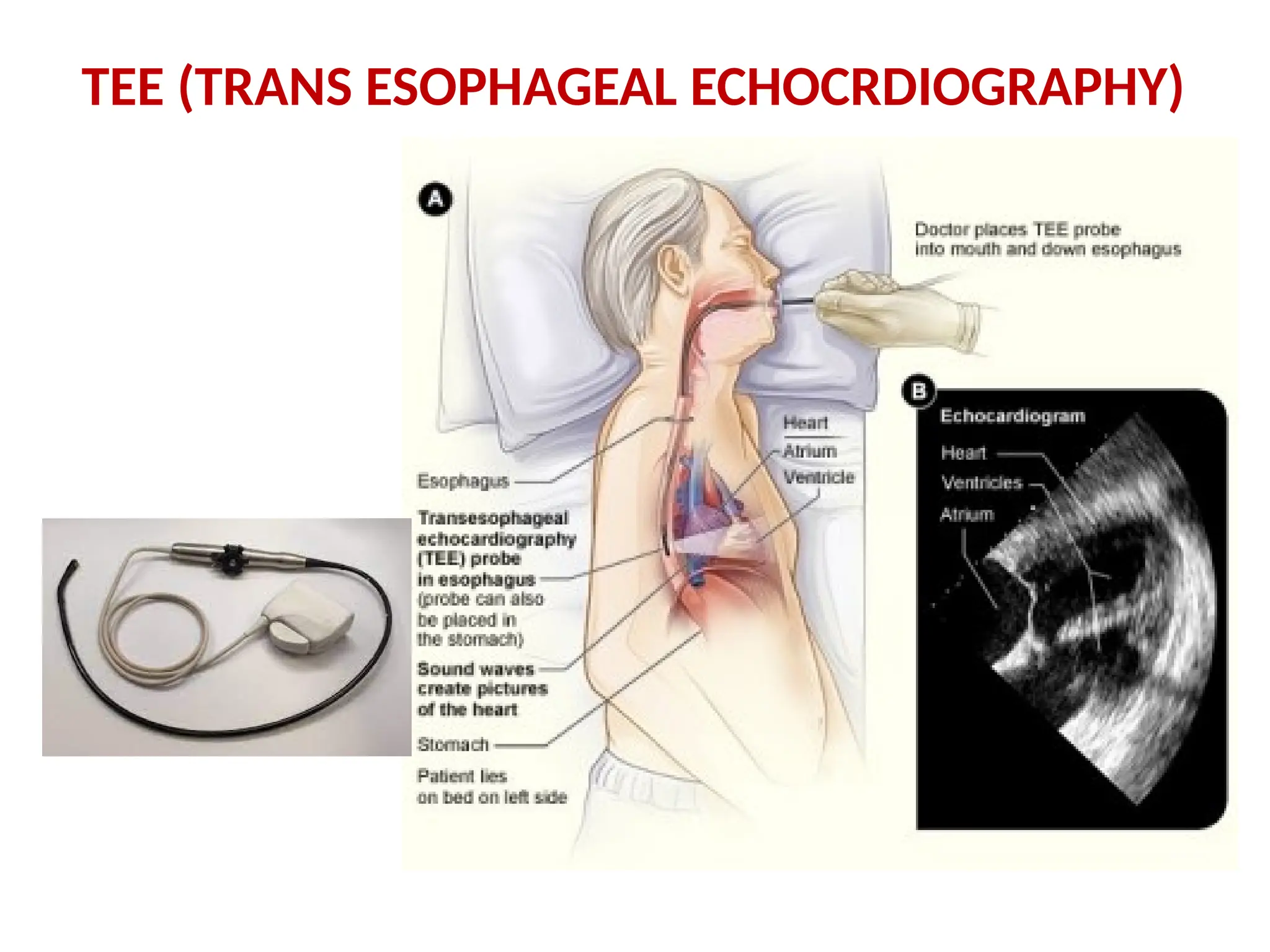 TEE (TRANS ESOPHAGEAL ECHOCRDIOGRAPHY)
 
