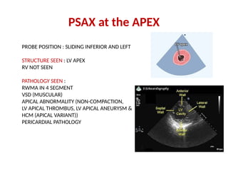 Basics of transoesphageal echocardiography | PPTX