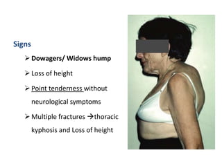 Signs
Dowagers/ Widows hump
Loss of height
Point tenderness without
neurological symptoms
Multiple fractures thoracic
kyphosis and Loss of height
 