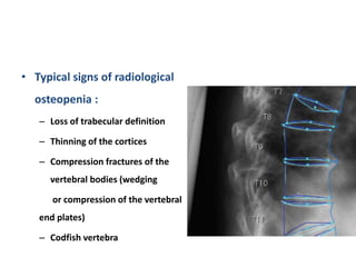 • Typical signs of radiological
osteopenia :
– Loss of trabecular definition
– Thinning of the cortices
– Compression fractures of the
vertebral bodies (wedging
or compression of the vertebral
end plates)
– Codfish vertebra
 