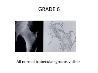 GRADE 6
All normal trabeculae groups visible
 
