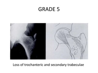 GRADE 5
Loss of trochanteric and secondary trabeculae
 