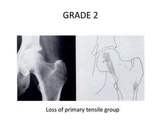 GRADE 2
Loss of primary tensile group
 