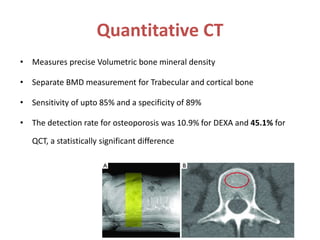 Quantitative CT
• Measures precise Volumetric bone mineral density
• Separate BMD measurement for Trabecular and cortical bone
• Sensitivity of upto 85% and a specificity of 89%
• The detection rate for osteoporosis was 10.9% for DEXA and 45.1% for
QCT, a statistically significant difference
 