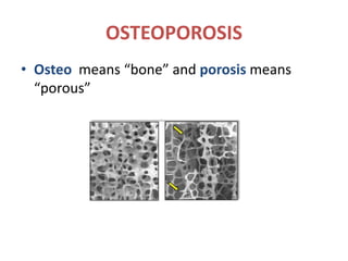 OSTEOPOROSIS
• Osteo means “bone” and porosis means
“porous”
 