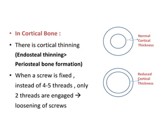 • In Cortical Bone :
• There is cortical thinning
(Endosteal thinning>
Periosteal bone formation)
• When a screw is fixed ,
instead of 4-5 threads , only
2 threads are engaged 
loosening of screws
Normal
Cortical
Thickness
Reduced
Cortical
Thickness
 
