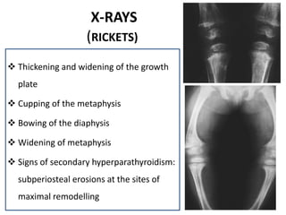  Thickening and widening of the growth
plate
 Cupping of the metaphysis
 Bowing of the diaphysis
 Widening of metaphysis
 Signs of secondary hyperparathyroidism:
subperiosteal erosions at the sites of
maximal remodelling
X-RAYS
(RICKETS)
 