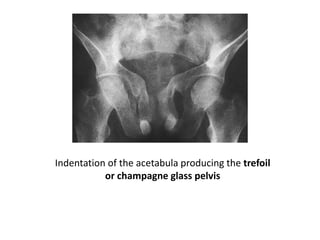 Indentation of the acetabula producing the trefoil
or champagne glass pelvis
 