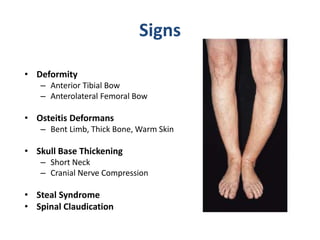 Signs
• Deformity
– Anterior Tibial Bow
– Anterolateral Femoral Bow
• Osteitis Deformans
– Bent Limb, Thick Bone, Warm Skin
• Skull Base Thickening
– Short Neck
– Cranial Nerve Compression
• Steal Syndrome
• Spinal Claudication
 