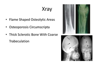 Xray
• Flame Shaped Osteolytic Areas
• Osteoporosis Circumscripta
• Thick Sclerotic Bone With Coarse
Trabeculation
 