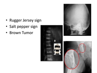 • Rugger Jersey sign
• Salt pepper sign
• Brown Tumor
 