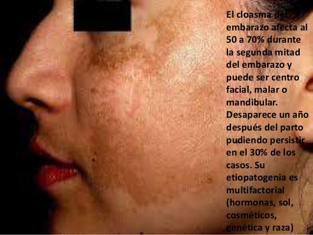 Como se librará de las pecas irecommend
