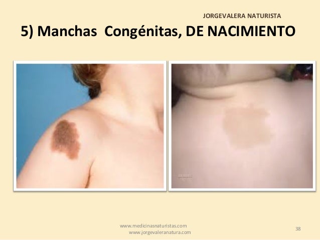 A que enfermedad las manchas de pigmento sobre la frente