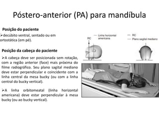 Póstero-anterior (PA) para mandíbula
Posição do paciente
➢decúbito ventral, sentado ou em
ortostática (em pé).
Posição da cabeça do paciente
➢A cabeça deve ser posicionada sem rotação,
com a região anterior (face) mais próxima do
filme radiográfico. Seu plano sagital mediano
deve estar perpendicular e coincidente com a
linha central da mesa bucky (ou com a linha
central do bucky vertical).
➢A linha orbitomeatal (linha horizontal
americana) deve estar perpendicular à mesa
bucky (ou ao bucky vertical).
 