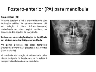 Póstero-anterior (PA) para mandíbula
➢Incide paralelo à linha orbitomeatalou com
inclinação cefálica de aproximadamente 12º
em relação à linha infraorbitomeatal,
centralizado no plano sagital mediano, na
topografia dos ângulos da mandíbula.
Raio central (RC)
Parâmetros de avaliação técnica da incidência
em póstero-anterior (PA) para mandíbula
•A ausência de rotação é evidenciada pelas
distâncias iguais da borda externa da órbita à
margem lateral do crânio de cada lado.
•As partes petrosas dos ossos temporais
(rochedos) devem estar projetadas nas órbitas
(transorbitária);
 