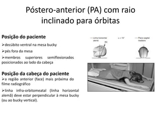 Póstero-anterior (PA) com raio
inclinado para órbitas
Posição do paciente
➢decúbito ventral na mesa bucky
➢pés fora da mesa
➢membros superiores semiflexionados
posicionados ao lado da cabeça
Posição da cabeça do paciente
➢a região anterior (face) mais próxima do
filme radiográfico
➢linha infra-orbitomeatal (linha horizontal
alemã) deve estar perpendicular à mesa bucky
(ou ao bucky vertical).
 