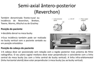 Semi-axial ântero-posterior
(Reverchon)
Também denominada fronto-nucal ou
incidência de Reverchon, Bretton,
Towne, Worms, Altschul ou de Grashey
Posição do paciente
➢decúbito dorsal na mesa bucky
➢Essa incidência também pode ser realizada
no bucky vertical com o paciente sentado ou
em posição ortostática
Posição da cabeça do paciente
➢A cabeça deve ser posicionada sem rotação com a região posterior mais próxima do filme
radiográfico. O seu plano sagital mediano deve estar perpendicular e coincidente com a linha
central da mesa bucky (ou com a linha central do bucky vertical). A linha infra-orbitomeatal
(linha horizontal alemã) deve estar perpendicular à mesa bucky (ou ao bucky vertical).
 