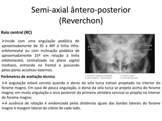 Semi-axial ântero-posterior
(Reverchon)
➢Incide com uma angulação podálica de
aproximadamente de 35 a 40º à linha infra-
orbitomeatal ou com inclinação podálica de
aproximadamente 25º em relação à linha
orbitomeatal, centralizado no plano sagital
mediano, entrando no frontal e passando
pelos poros acústicos externos.
Raio central (RC)
Parâmetros de avaliação técnica
➢A angulação estará correta quando o dorso da sela turca estiver projetado no interior do
forame magno. Em caso de pouca angulação, o dorso da sela turca se projeta acima do forame
magno; em muita angulação o arco posterior da primeira vértebra cervical se projeta no interior
do forame magno;
➢A ausência de rotação é evidenciada pelas distâncias iguais das bordas laterais do forame
magno à margem lateral do crânio de cada lado.
 