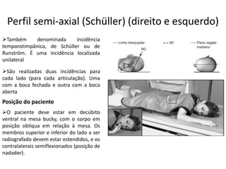 Perfil semi-axial (Schüller) (direito e esquerdo)
➢São realizadas duas incidências para
cada lado (para cada articulação). Uma
com a boca fechada e outra com a boca
aberta
➢Também denominada incidência
temporotimpânica, de Schüller ou de
Runström. É uma incidência localizada
unilateral
Posição do paciente
➢O paciente deve estar em decúbito
ventral na mesa bucky, com o corpo em
posição oblíqua em relação à mesa. Os
membros superior e inferior do lado a ser
radiografado devem estar estendidos, e os
contralaterais semiflexionados (posição de
nadador).
 