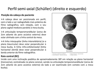 Perfil semi-axial (Schüller) (direito e esquerdo)
➢A linha interpupilar (linha interorbitária) (e o
plano biauricular) deve estar perpendicular à
mesa bucky. A linha infra-orbitomeatal (linha
horizontal alemã) deve estar perpendicular à
borda anterior do filme radiográfico.
Posição da cabeça do paciente
➢A cabeça deve ser posicionada em perfil,
com o lado a ser radiografado mais próximo do
filme radiográfico, sem rotação, com o seu
plano sagital mediano paralelo à mesa bucky.
➢A articulação temporomandibular (cerca de
2cm adiante do poro acústico externo) deve
estar alinhada com a linha central da mesa.
Incide com uma inclinação podálica de aproximadamente 30º em relação ao plano horizontal
(transverso), centralizado no plano coronal, saindo na articulação temporomandibular (cerca de
2cm adiante do poro acústico externo) do lado a ser examinado (em contato com a mesa
bucky).
Raio central (RC)
 