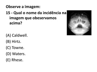 Observe a imagem:
15 - Qual o nome da incidência na
imagem que obeservamos
acima?
(A) Caldwell.
(B) Hirtz.
(C) Towne.
(D) Waters.
(E) Rhese.
 