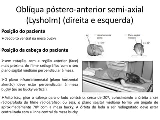 Oblíqua póstero-anterior semi-axial
(Lysholm) (direita e esquerda)
Posição do paciente
➢decúbito ventral na mesa bucky
Posição da cabeça do paciente
➢sem rotação, com a região anterior (face)
mais próxima do filme radiográfico com o seu
plano sagital mediano perpendicular à mesa.
➢O plano infraorbitomeatal (plano horizontal
alemão) deve estar perpendicular à mesa
bucky (ou ao bucky vertical)
➢Feito isso, girar a cabeça para o lado contrário, cerca de 20º, aproximando a órbita a ser
radiografada do filme radiográfico, ou seja, o plano sagital mediano forma um ângulo de
aproximadamente 70º com a mesa bucky. A órbita do lado a ser radiografado deve estar
centralizada com a linha central da mesa bucky.
 