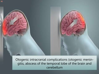Otogenic intracranial complications (otogenic menin-
gitis, abscess of the temporal lobe of the brain and
cerebellum
 