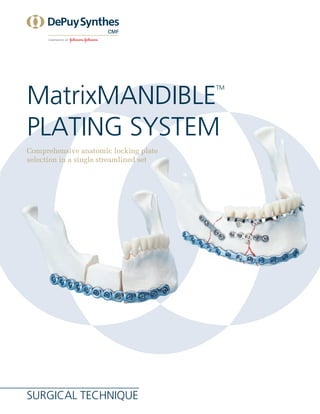 Surgical Technique
MatrixMANDIBLE
TM
plating system
Comprehensive anatomic locking plate
selection in a single streamlined set
 