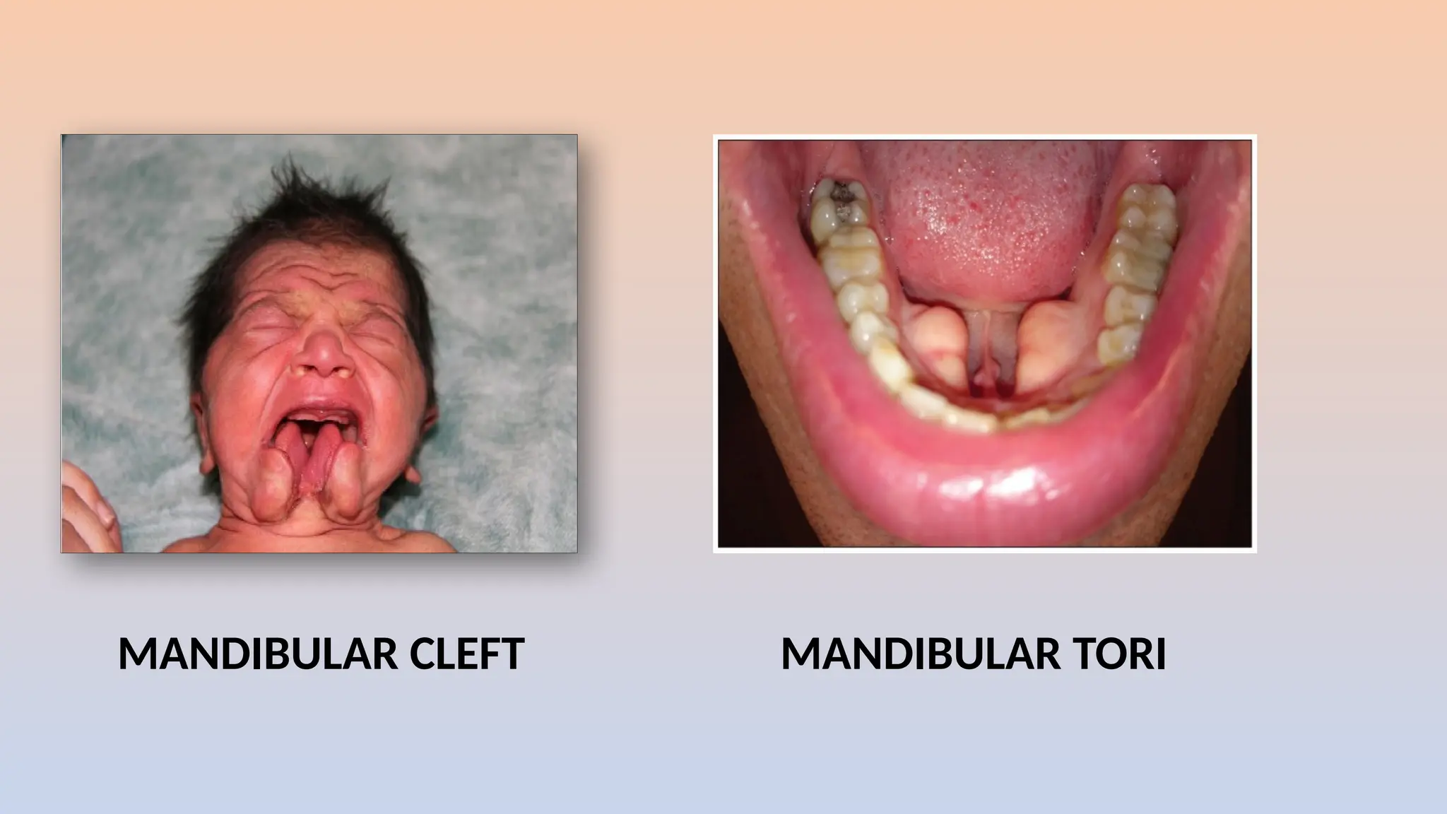 MANDIBULAR CLEFT MANDIBULAR TORI
 