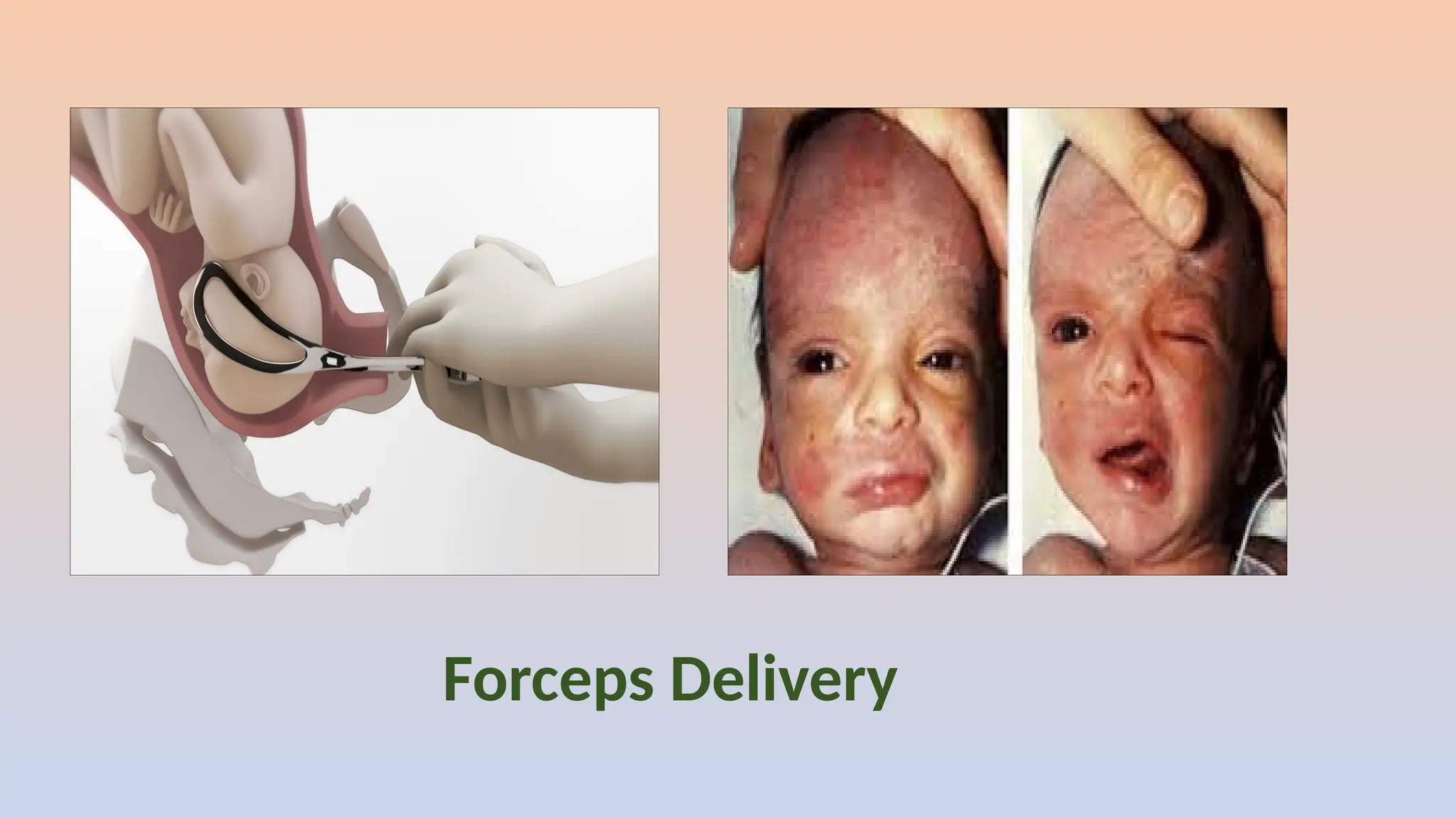 Forceps Delivery
 