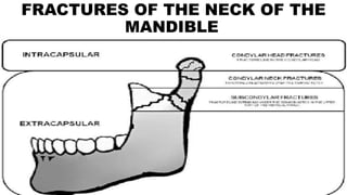 FRACTURES OF THE NECK OF THE
MANDIBLE
 