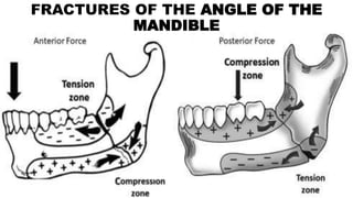 FRACTURES OF THE ANGLE OF THE
MANDIBLE
 